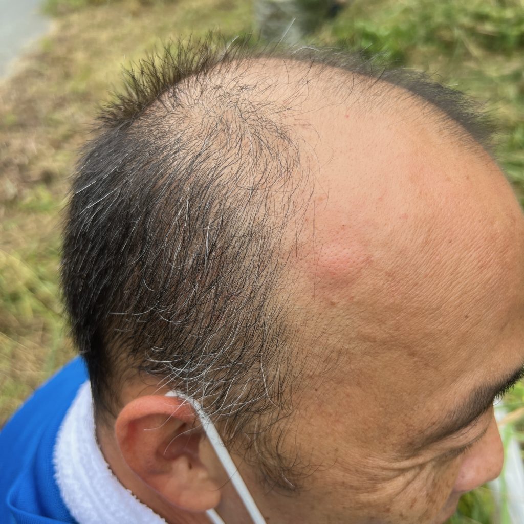 おでこを蚊にさされた